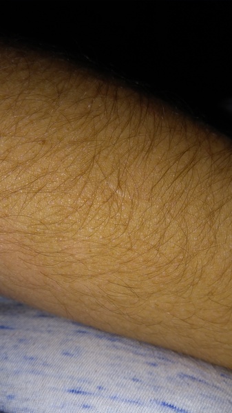 To ask about scarring after huge cut? Have you dcs had scars?