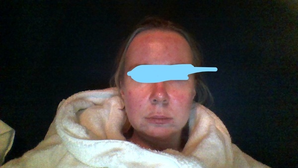 Face tinkerers - Profhilo is flippin' brill