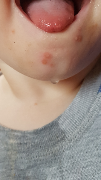 Is this chicken pox
