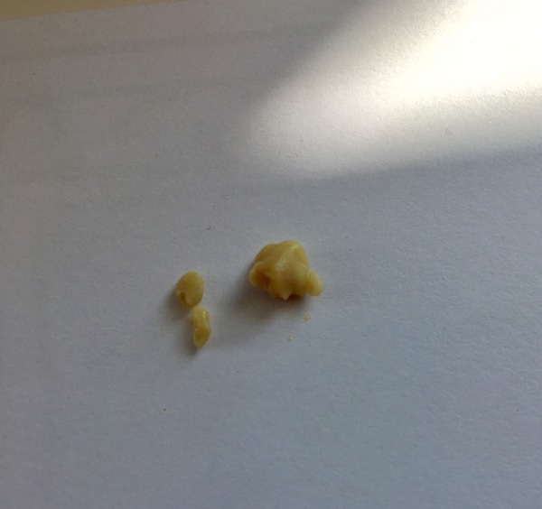 Tonsil stones