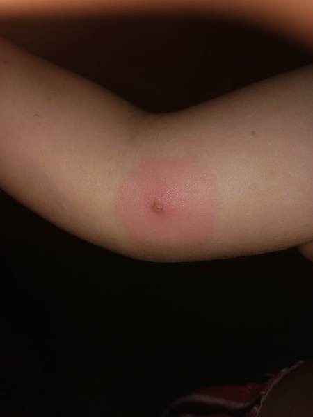 Does this look like impetigo