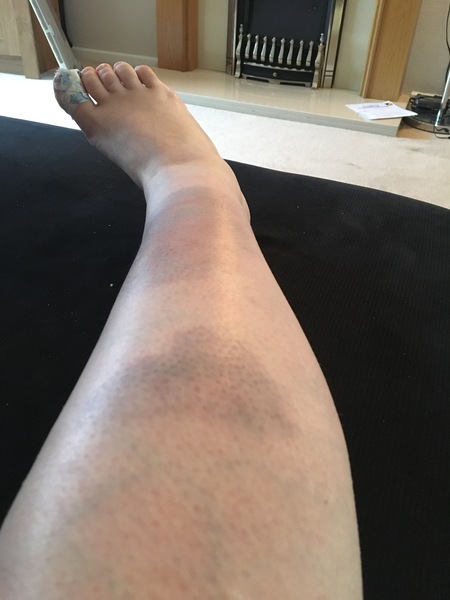 Numpty injuries