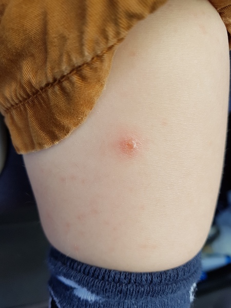 Is this chicken pox
