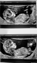 13 week scan