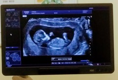 13 week scan