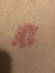 What is this on my husbands back???