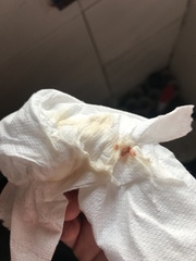 37+2 does this look like my mucous plug?