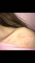 Is this rash worrying? (pic)
