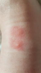 What bit me?
