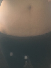 Do stretch makes worsen with another pregnancy?