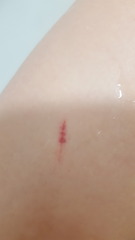 Cat scratch is purple - infected??
