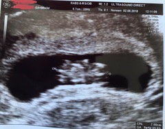Fresh Start thread for pregnancy after miscarriage or loss