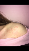 Is this rash worrying? (pic)