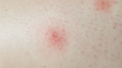 What bit me?