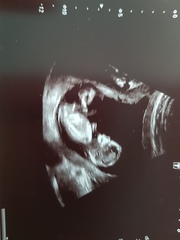 Boy or girl at 13 weeks?