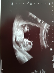 Boy or girl at 13 weeks?