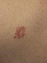 What is this on my husbands back???