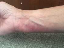 Might it be scabies? (photos - sorry)