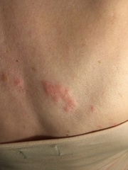 On holiday and think I have shingles - is it vital I see a GP?