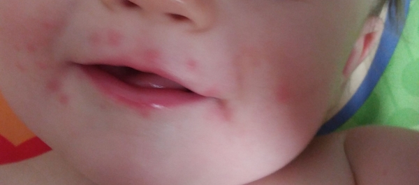 Is this chicken pox?