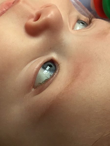 Eyeball shape?