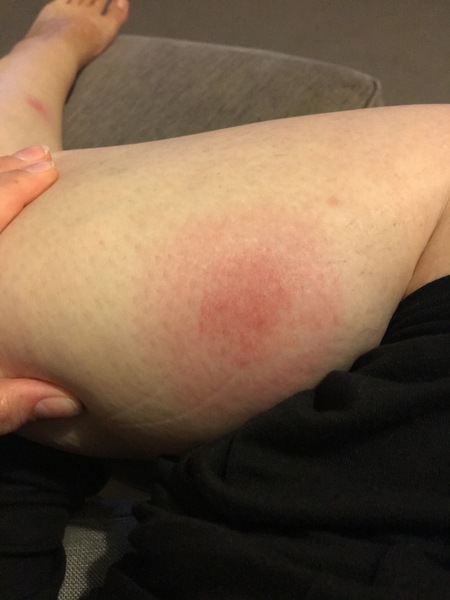 Bullseye rash