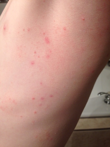 Molluscum Contagiosum