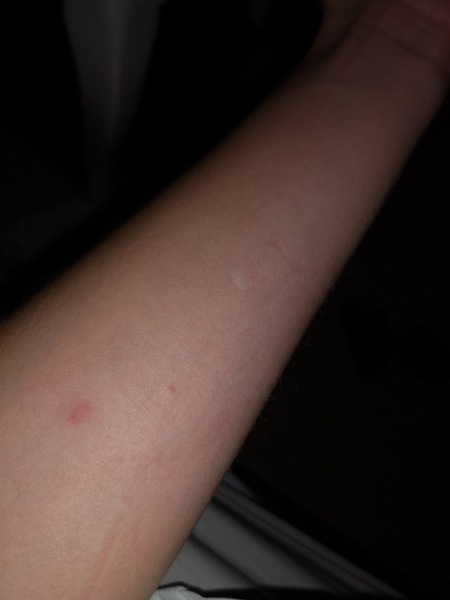 What bug has bitten me ? Picture