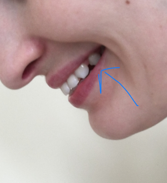 So unhappy with my smile - any dentists or orthodontists about? Photos attached