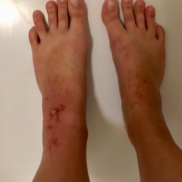 Will my foot fall off if I wait until morning?