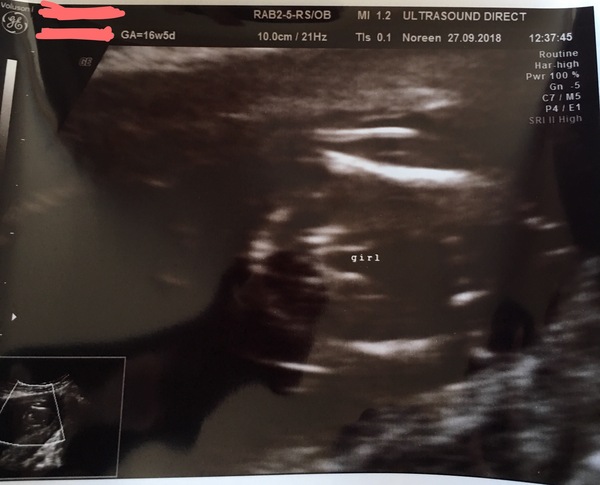 How accurate are sexing scans at 17 weeks?