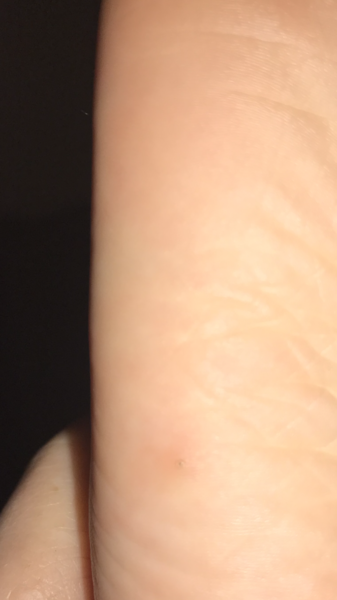 Verruca or splinter??