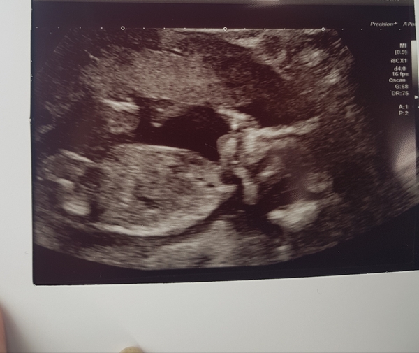 20 week scan, boy or girl?