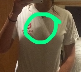 Chest lump (photo)