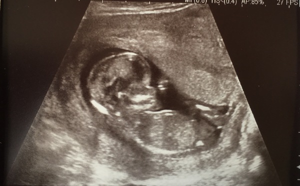 Gush of blood at 12 weeks? Terrified!