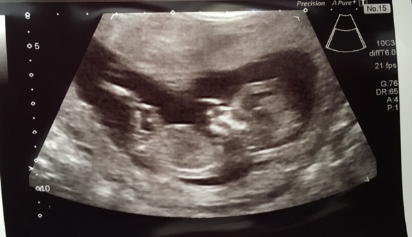 Pregnancy after loss: spring 2019 edition (The Brexit Babes) 🐧