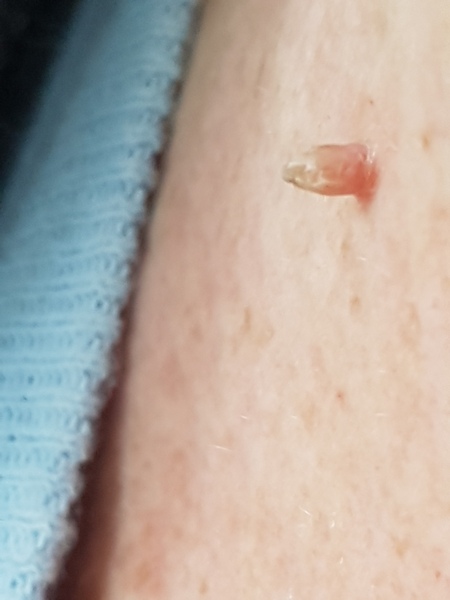 Skin tag on neck