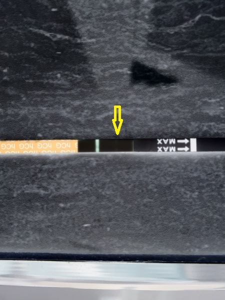 Post-IVF squinter - please tell me this is a line?
