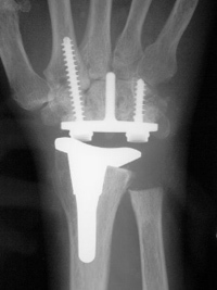 To ask if anyone’s had a wrist replacement?