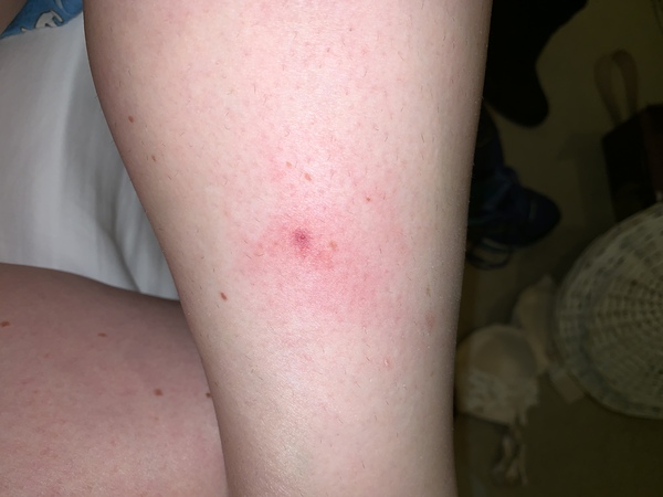 Suspected tick bite