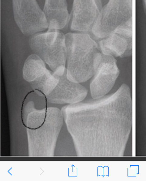 Sons wrist fractured in 2 places