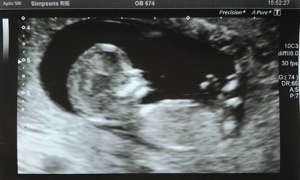 Pregnancy after loss: spring 2019 edition (The Brexit Babes) 🐧