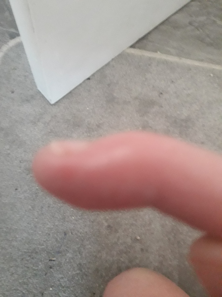 Mallet finger or something else?