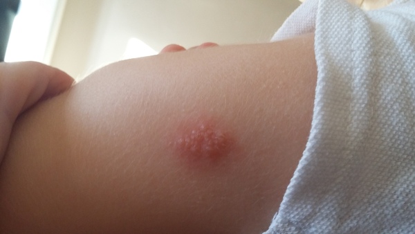 What is this on my childs arm
