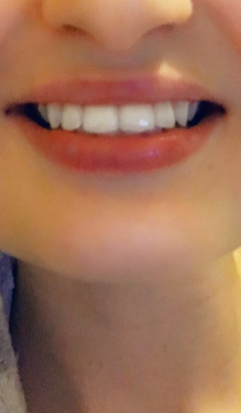 So unhappy with my smile - any dentists or orthodontists about? Photos attached