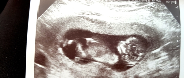 Nub Theory.. Girl or Boy ?