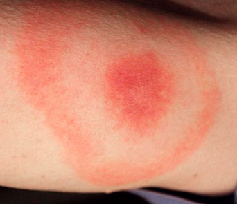 Suspected tick bite