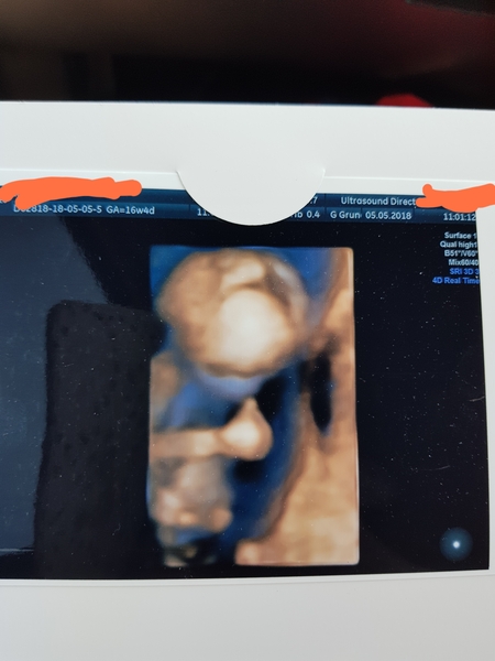 Anyone else have a weird looking 3D scan?