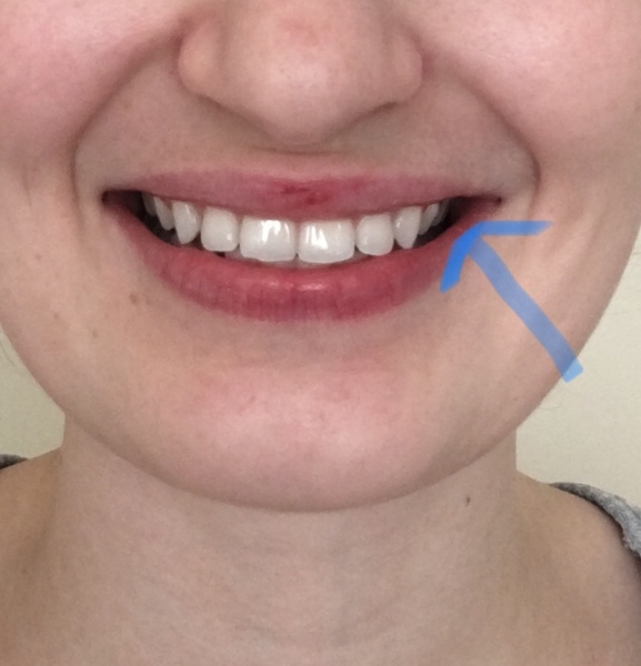 So unhappy with my smile - any dentists or orthodontists about? Photos attached
