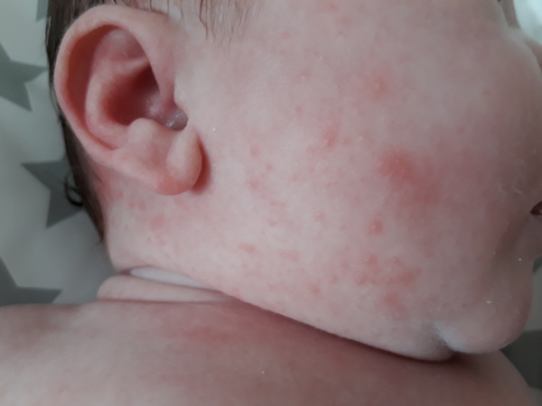Help please pimples on newborn skin?